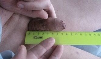 measurement of penis size